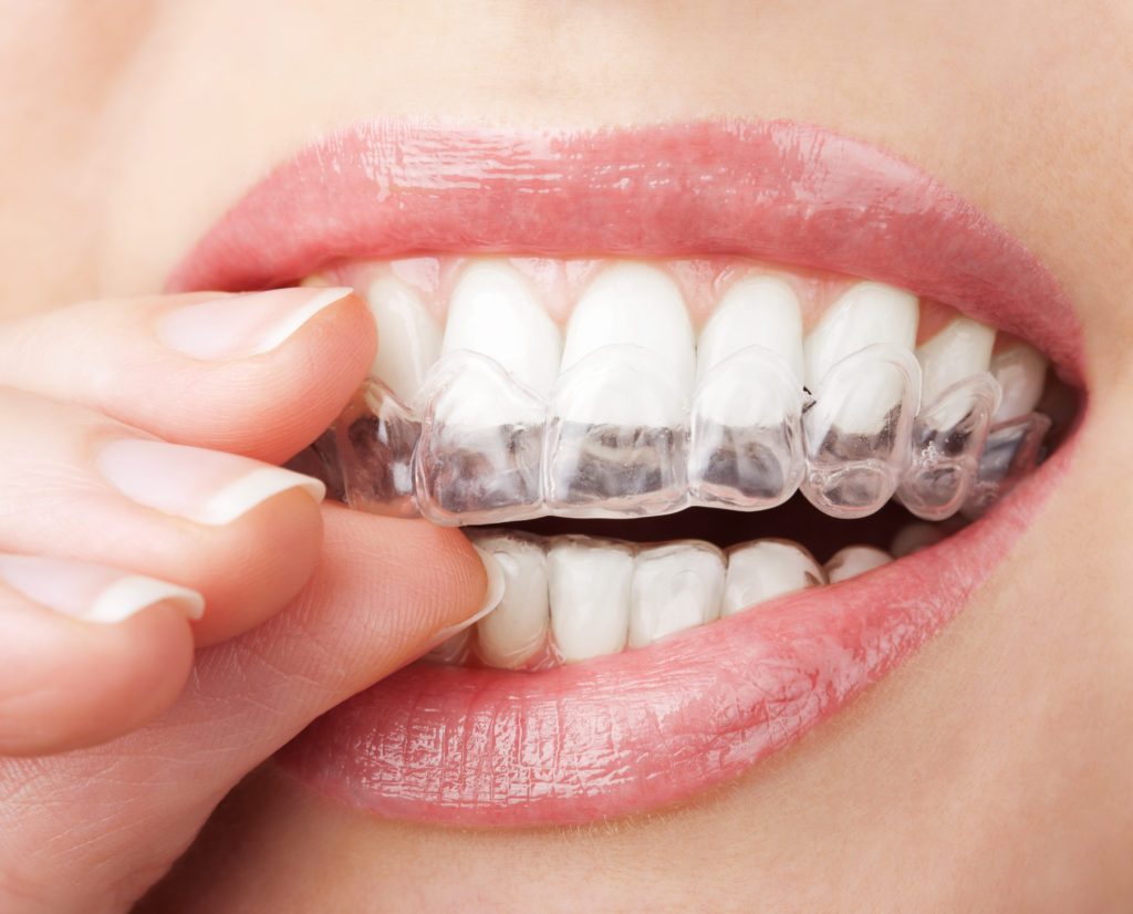 Discovering a Expert Dentist Carrying Out a Secure Invisalign Exton Therapy