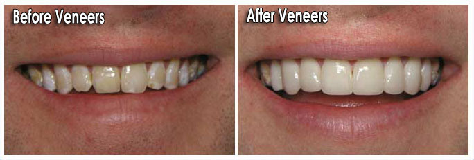 Dental Veneers Can Fix Damaged, Crooked & Discoloured Teeth