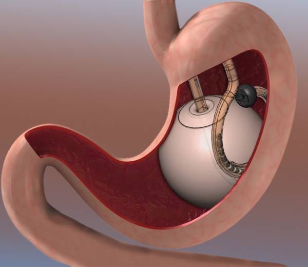 Benefits of Gastric Balloon Technology